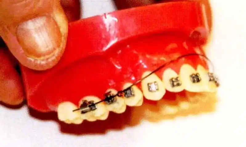 第二节 带圈摇椅弓的弯制步骤及临床应用