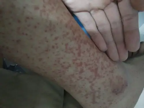 腿上脚上起斑最近两三天以前没有过不疼不痒