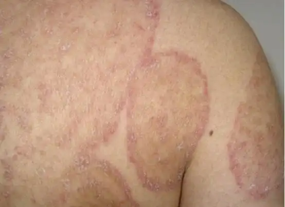 1,什么是体癣?体癣是皮肤癣菌引起的光滑皮肤上的浅部真菌感染.