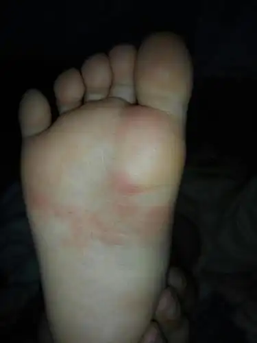 三岁宝宝脚底有一篇红疙瘩过会儿就喊痒,能用婴宝吗?