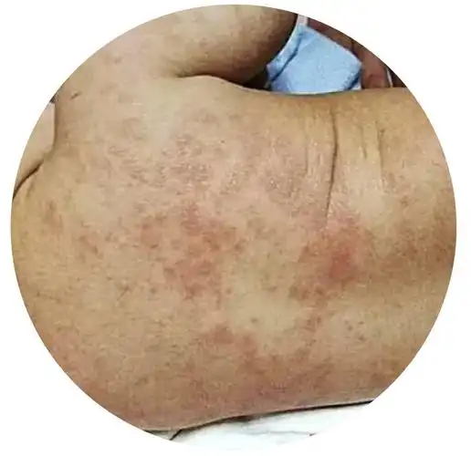 夏天宝宝防痱子这些产品不靠谱内附痱子防治攻略