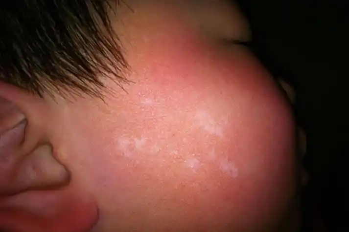 白癜风早期症状图