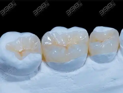 看嵌体补牙和树脂补牙的区别详解就知道嵌体有必要做吗