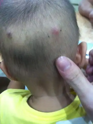 1岁五个月的儿子后脑勺耳朵后长了两个包,摸起来有点硬,而且他又不痛
