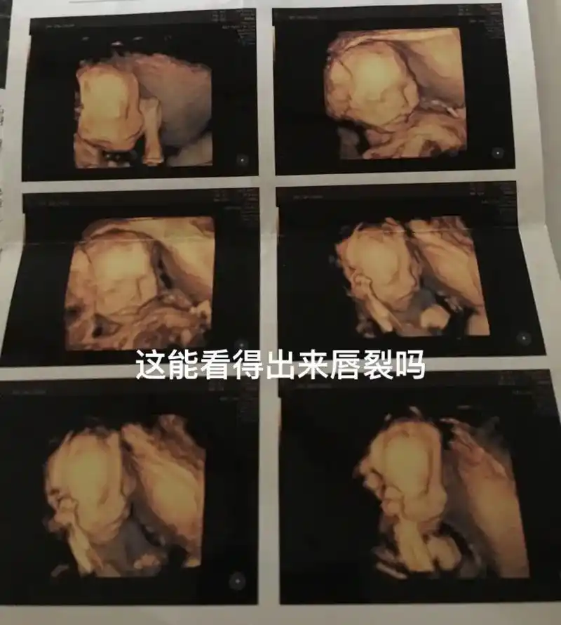 四维的图片能不能看出唇裂呢?