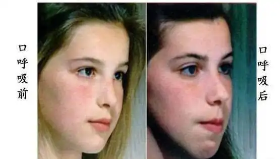长期用嘴呼吸的人,真的会越来越丑,科学已验证