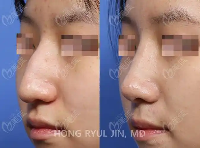 鹰钩鼻矫正前后对比图