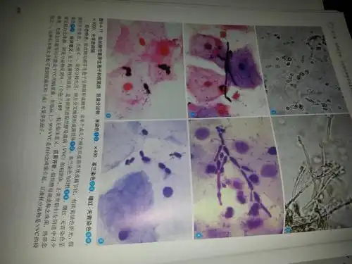 医学检验显微镜下白带常规如何才能看出有霉菌,只知道在调节细微螺旋