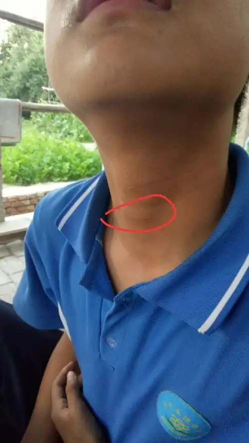 喉咙疼吃了各种消炎药,还是没有下去,且喉结下面有一点肿像第二个喉结