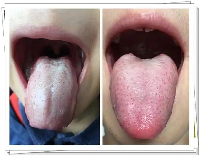 小儿舌诊临床案例—派派舌象变化带来的启示声音免费