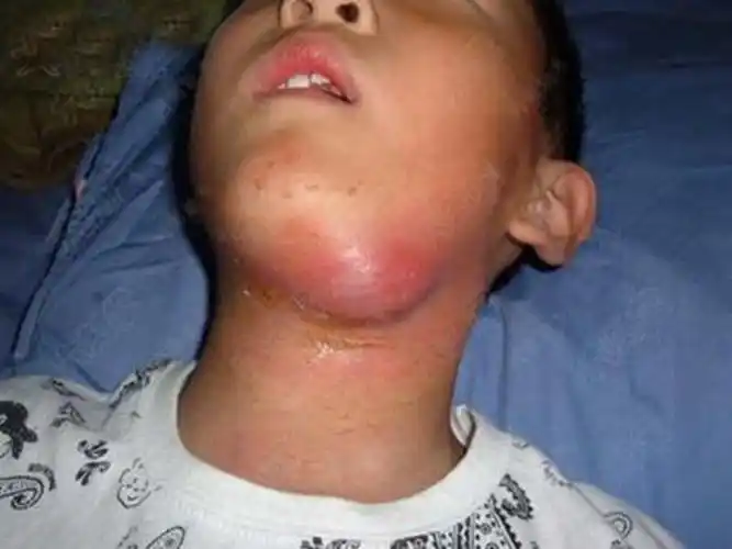 脖子淋巴瘤早期图片_有来医生