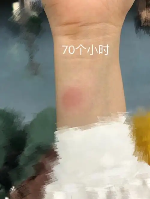 因为ppd皮试结果被护士判定了两个加的阳性(图三),这两天特别煎熬,睡