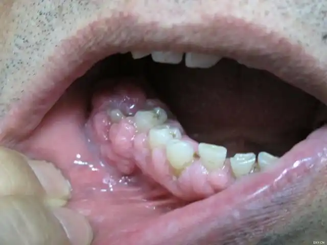 【求助】牙龈增生图片,治疗,请大家支招