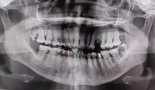 慢性根尖周炎致面瘘1例