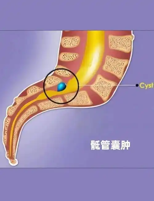 只有约15%的骶管囊肿才会引起神经压迫,导致患者出现临床症状,这时才