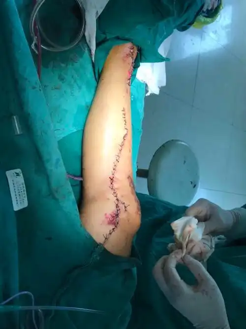 多例小腿外伤的抢救治疗——外二科为了病人的健康在前进