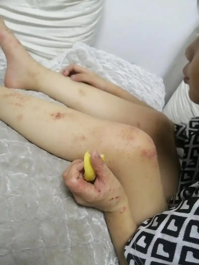 求助万能的朋友们   孩子四肢起疙瘩伴有脓包 奇痒难忍  反 - 抖音