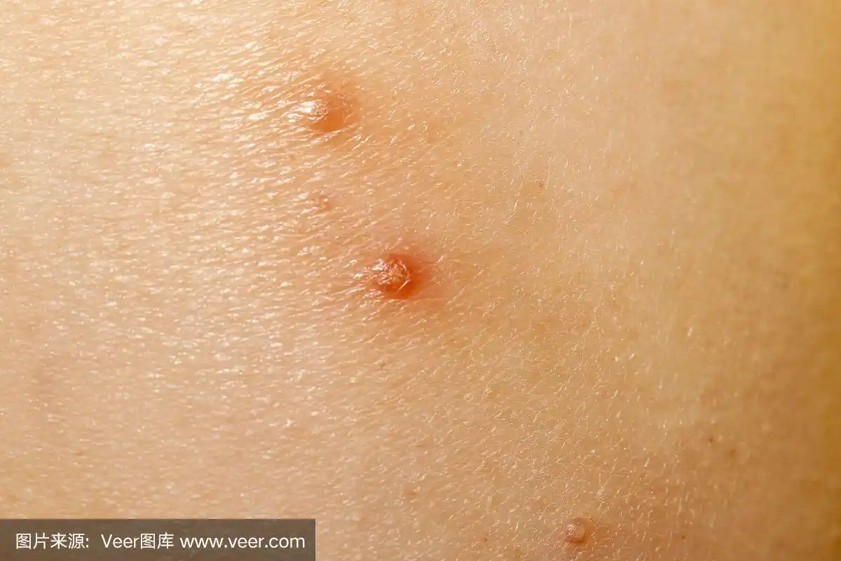 传染性软疣的特写也叫水疣