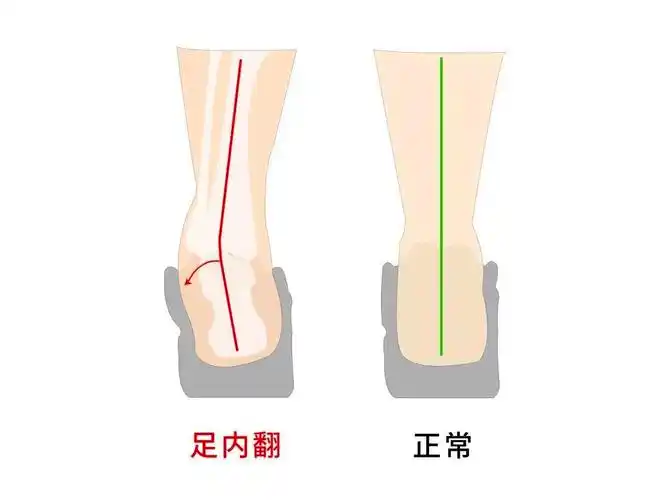 孩子足内翻怎么办如何预防