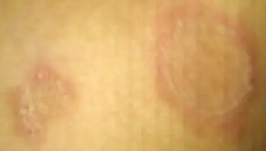 大腿内侧有俩红圈圈很痒 求支招!