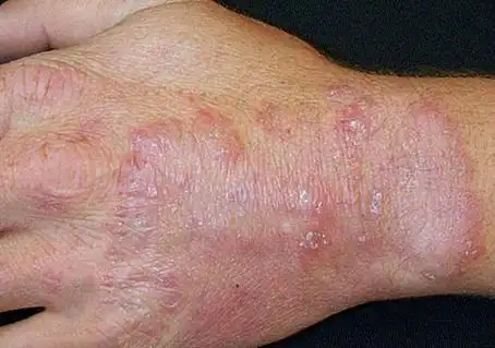 癣,念珠菌,花斑癣只是真菌感染皮肤病的一些例子.