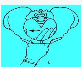 当测量坐骨结节间径 8cm,耻骨弓角度 900时,应进一步测量哪条径线 ( )