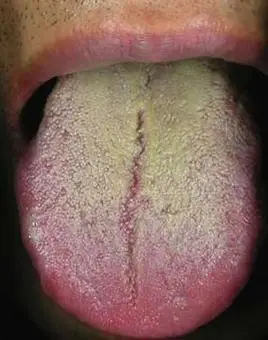 舌苔胖大有齿痕是身体什么信号