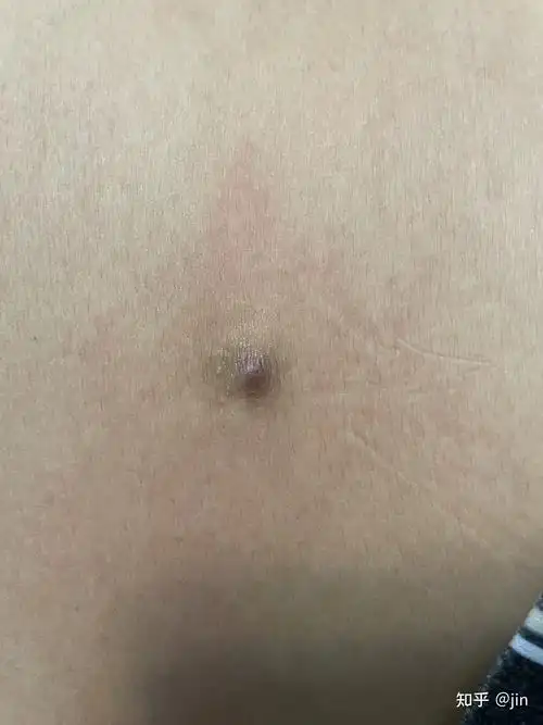 肚子上长了个小疙瘩