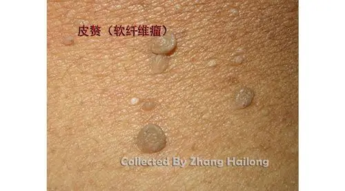 脂肪粒怎么去换眼霜不如用这招