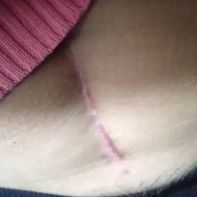 我破腹产三个月了.头胎看看我的刀疤这样的.不知道其他宝妈怎麼样.