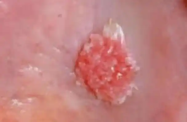 菜花状尖锐湿疣