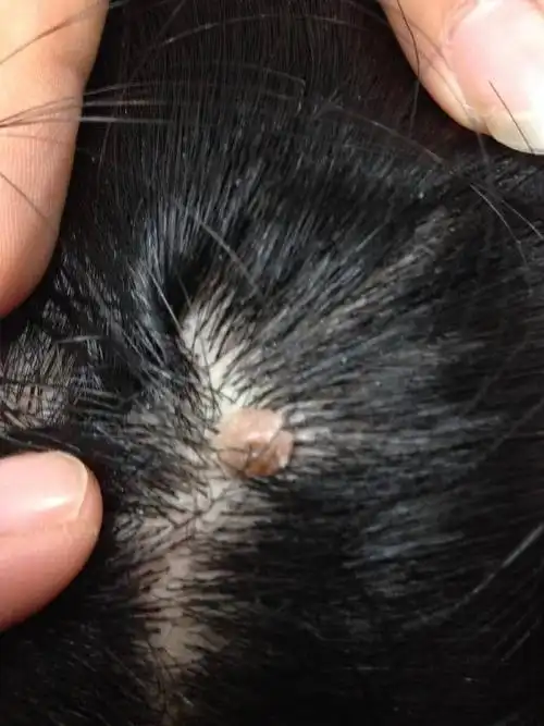 头皮上有很多这样的疙瘩,请问是什么啊,严重吗?