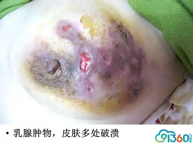 肉芽肿性小叶性乳腺炎进展与思考