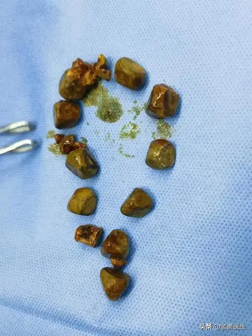 手术|石术|医生|胆囊结石_网易订阅