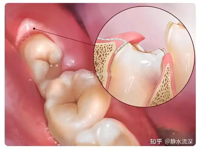 当发生智齿冠周炎的时候,智齿旁边的牙床会发生肿胀,发炎(红,肿,痛)