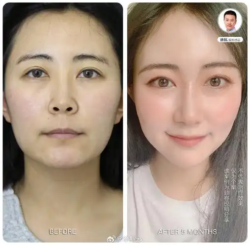 露鼻孔朝天鼻,做完鼻综合会什么样呢?