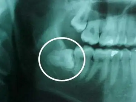 通常智齿萌发的空间不足,而会倒在第二大臼齿上,因而造成第二大臼齿