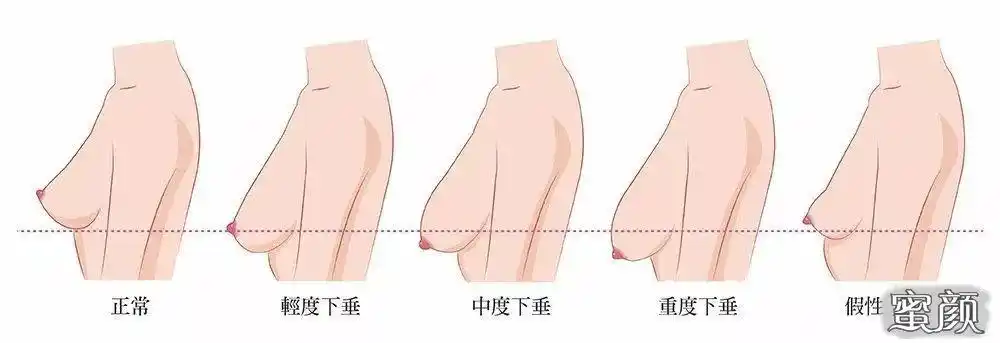 有必要将乳房位置低下的概念与下垂区分开来,蛋白质摄入不足,热水冲刷