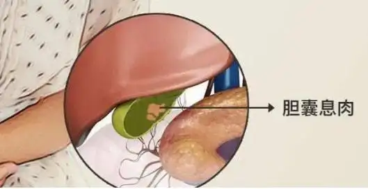 胆囊息肉最佳治疗方法(胆囊息肉最佳治疗方法胆囊息肉切除)-尚蒂健康
