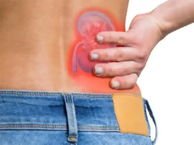 肾结石的症状与预防