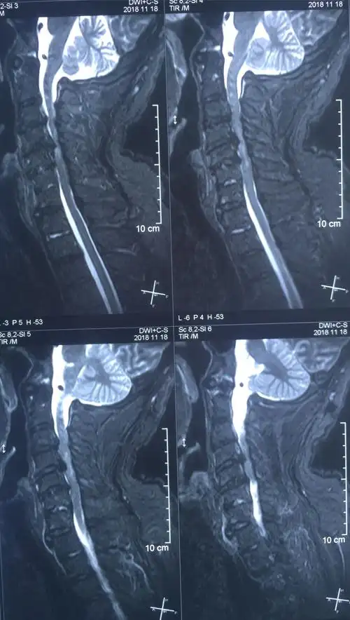 颈椎外伤致瘫痪,妙手术后完美痊愈