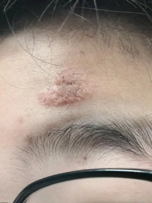 额头皮脂腺痣手术切除后即刻图片#解决皮肤问题专注皮肤美容##美容