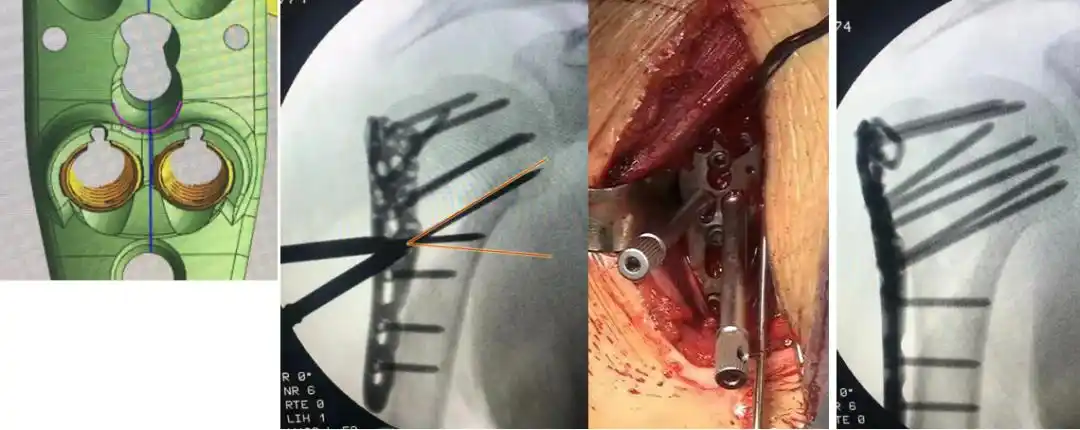 病例分享丨肱骨近端外翻嵌插四部分骨折