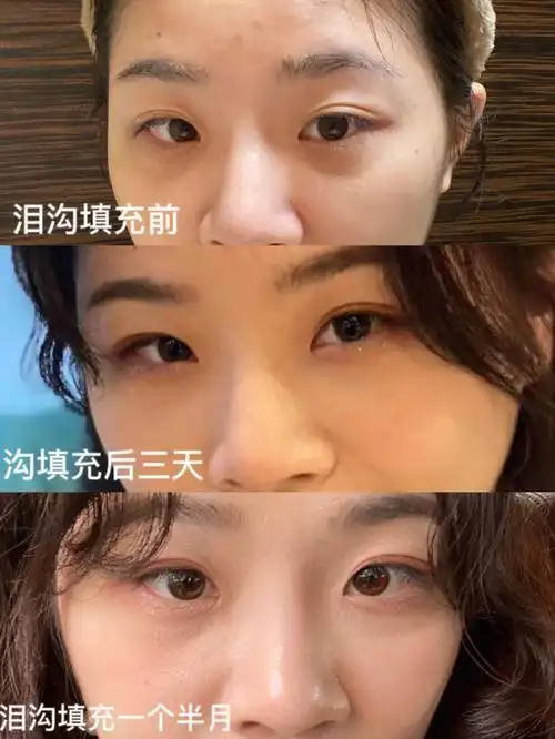 泪沟填充一个半月,唠唠心里话