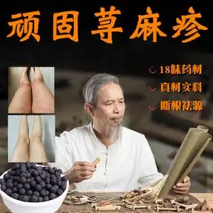 慢性急性荨麻疹过敏止痒去根源专用内服丸中药克星人工胆碱能丘疹