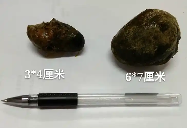 正常人的胆管约6-8毫米,但近日,外四科成功为一例巨大胆管结石合并肝