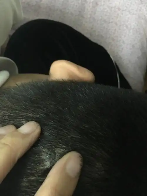 儿子头后面长了一个黑痣,不痛不痒的要不要紧啊?