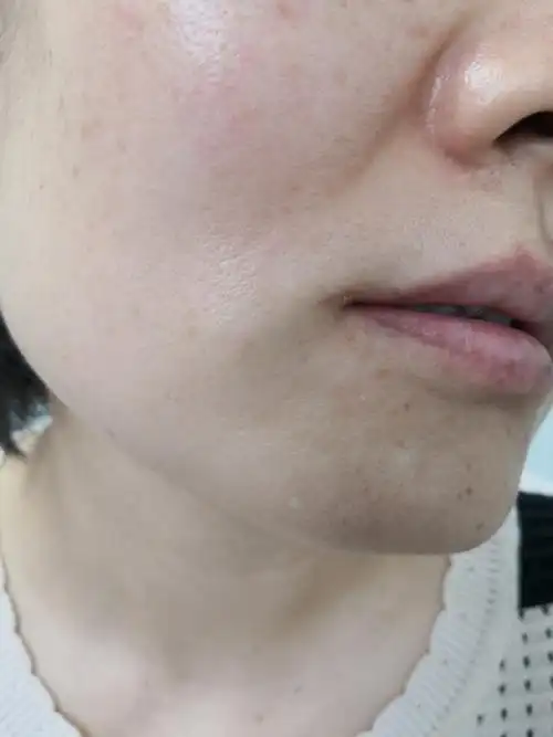 口角右侧的白斑症状.多年白癜风症状,治疗后减轻!