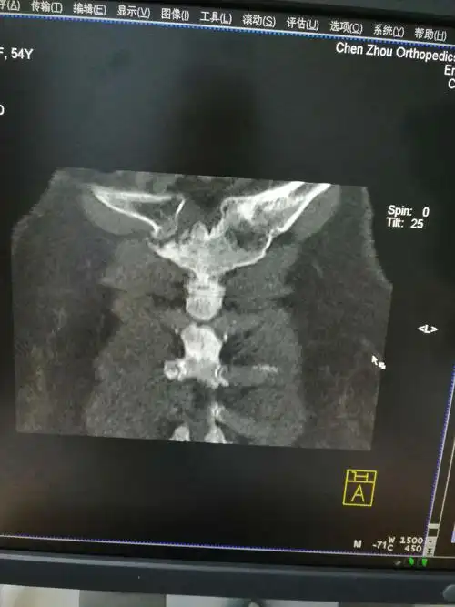 女性,54岁,胸骨柄突起畸形数年,偶尔疼痛