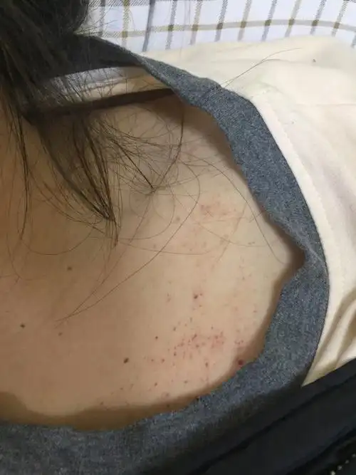 皮肤下出血点图片_血小板减少出血点紫癜症状_皮肤小红点 - 血小板低